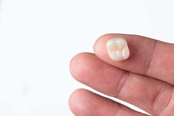 5 FAQs About CEREC® Crowns