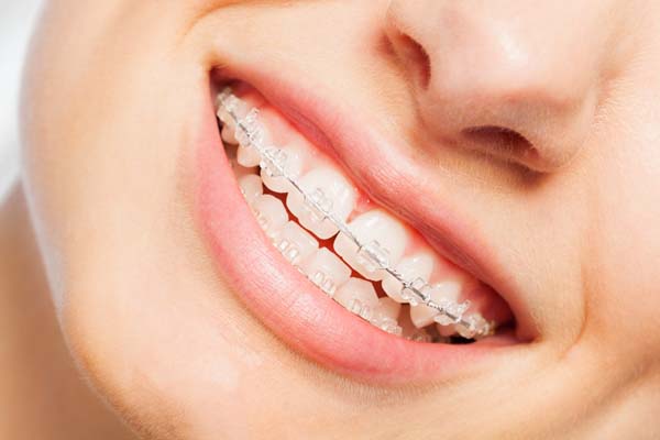 Benefits of Clear Braces