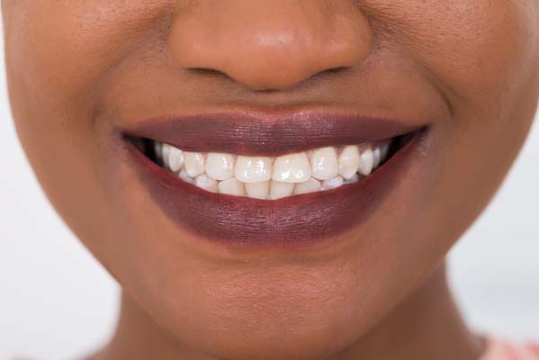 Dental Bonding to Improve Appearance of Front Teeth