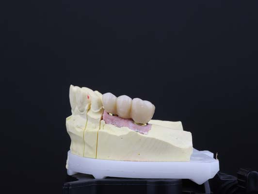 How a Dental Bridge Is Held in Place