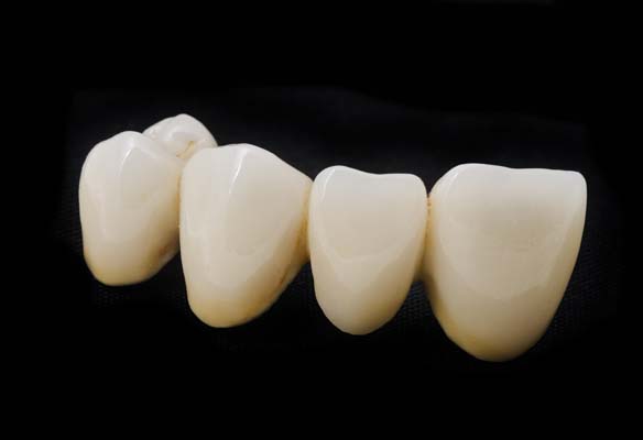 4 Types of Dental Bridges