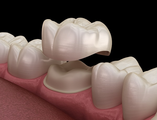 When are Dental Crowns Recommended by Dentists?