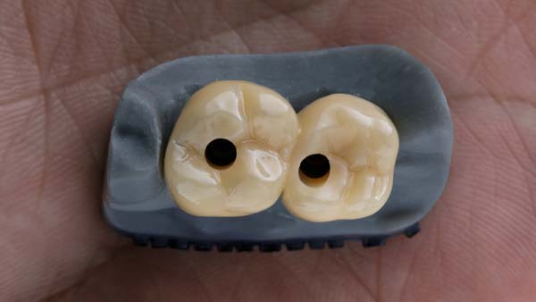 Multiple Dental Implants vs. Dental Bridge