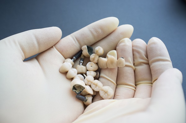 How Long Does a Full Mouth Reconstruction Take?