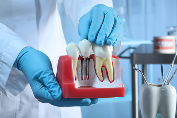 A Step-by-Step Guide to Implant Restoration