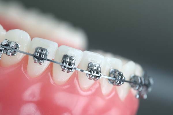 Orthodontics: How Do Clear Braces Work to Straighten Teeth?