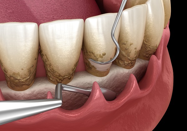 Three Tips for Choosing the Right Dentist for Periodontics Treatment