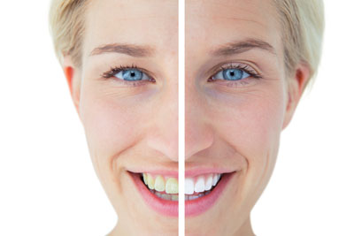 What You Should Know About Teeth Whitening Home Kits