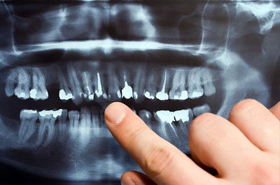 The Process of Wisdom Teeth Extraction